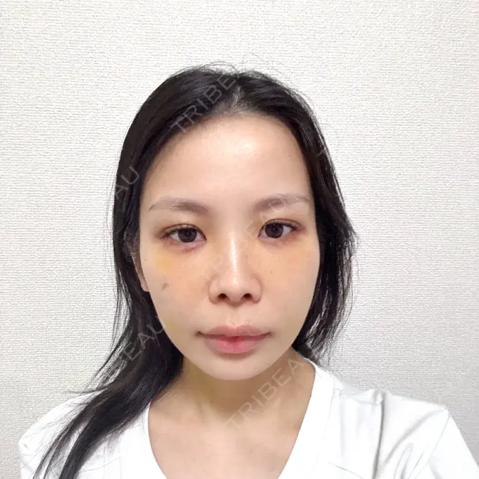 脂肪吸引（顔） 小倉美容外科ネビュラクリニック DAY 6 メイン用