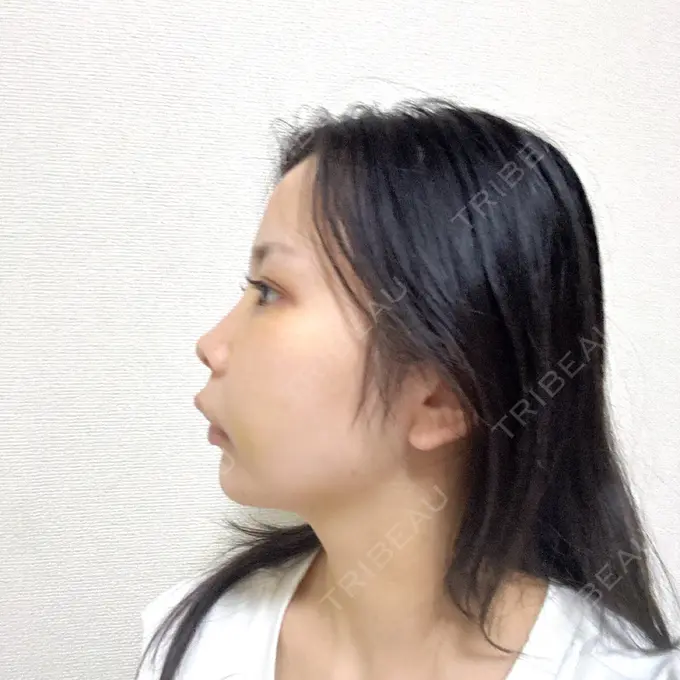 脂肪吸引（顔） 小倉美容外科ネビュラクリニック DAY 6 メイン用