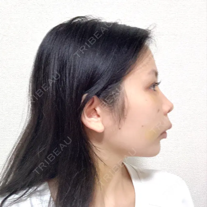 脂肪吸引（顔） 小倉美容外科ネビュラクリニック DAY 6 メイン用