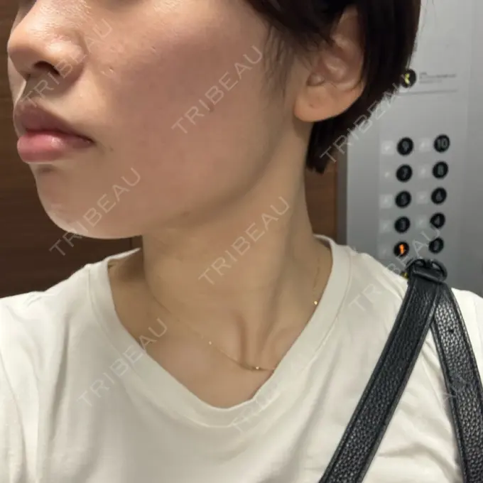 ボトックス（エラ・小顔） 新未来クリニック DAY 0 メイン用