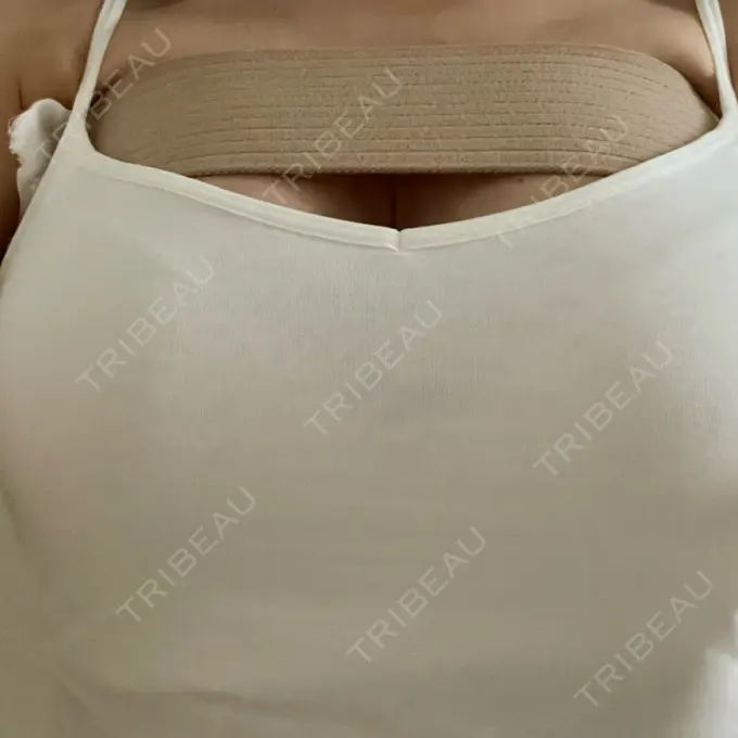 豊胸（シリコンバッグ） / その他（胸） ルーチェクリニック 銀座院 AFTER メイン用