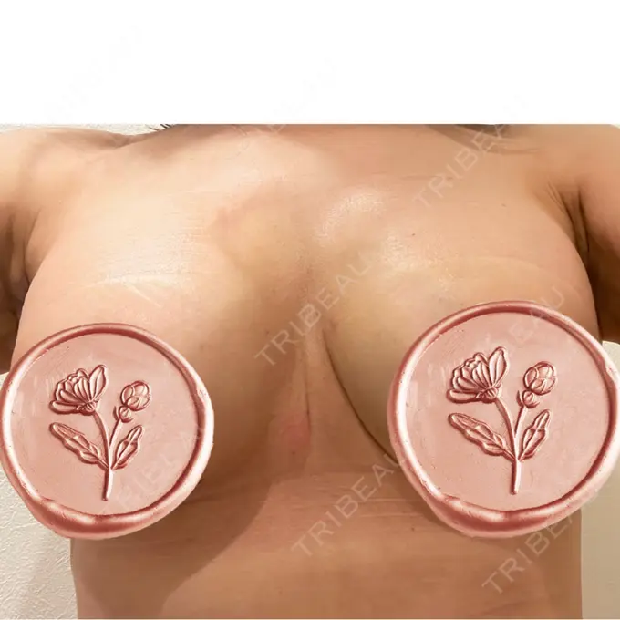 豊胸（シリコンバッグ） / その他（胸） ルーチェクリニック 銀座院 DAY 35 メイン用