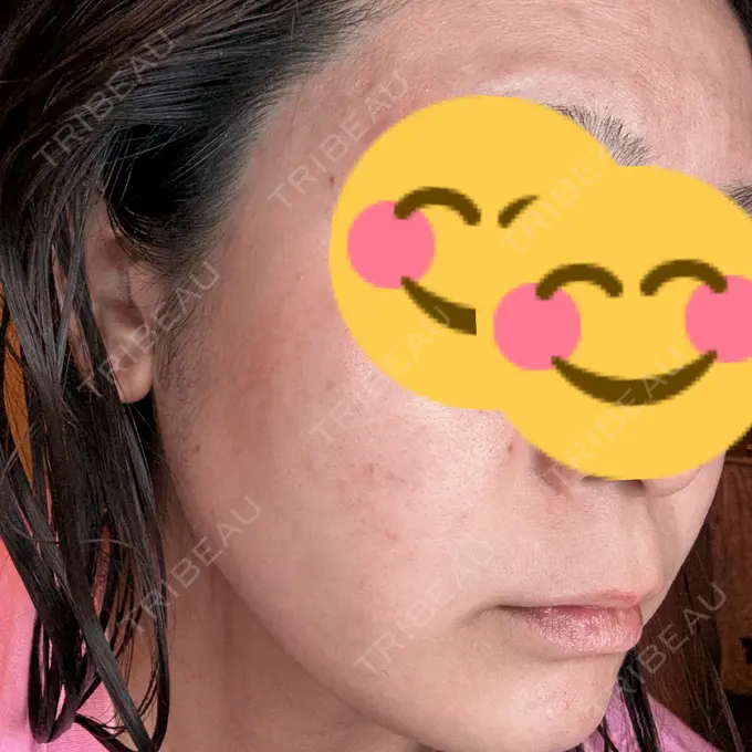 ピーリング（ニキビ・毛穴） / エレクトロポレーション / レーザートーニング（美白・肝斑） 新宿美容外科クリニック 新宿院 AFTER メイン用