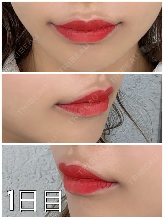 アートメイク（唇） 筋肉・美容クリニック DAY 1 メイン用