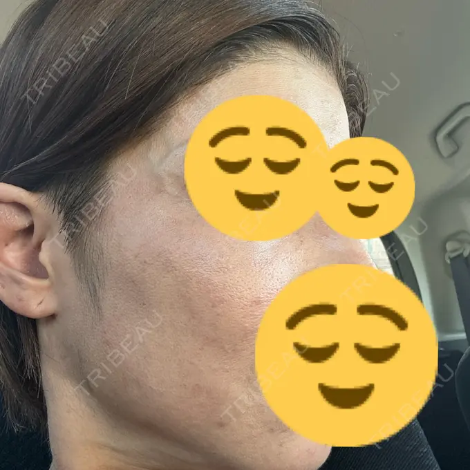 エレクトロポレーション / ピコレーザートーニング（美白・肝斑） 栄美容クリニック 栄院 DAY 18 メイン用