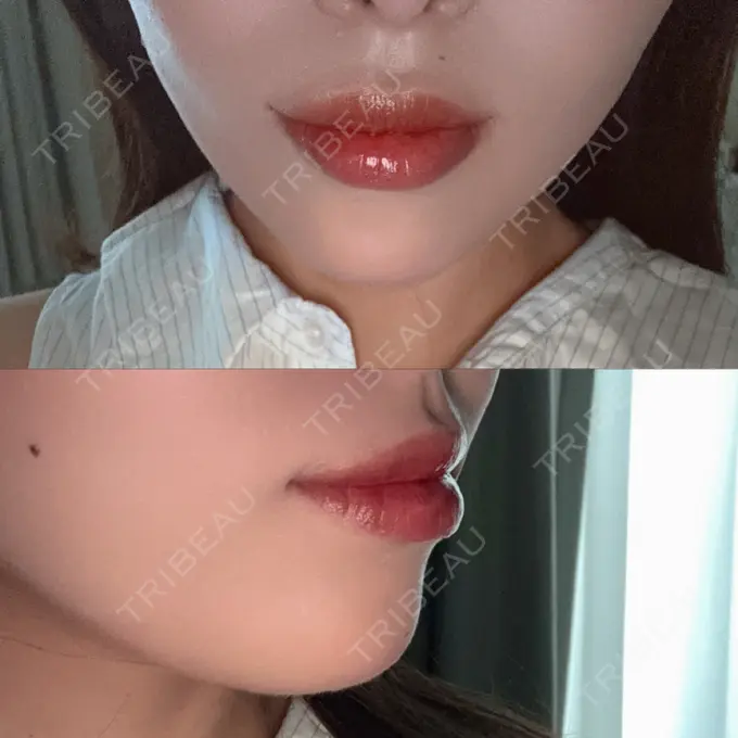 ボトックス（あご） / ボトックス（口角） 表参道ウィズ・クリニック AFTER メイン用