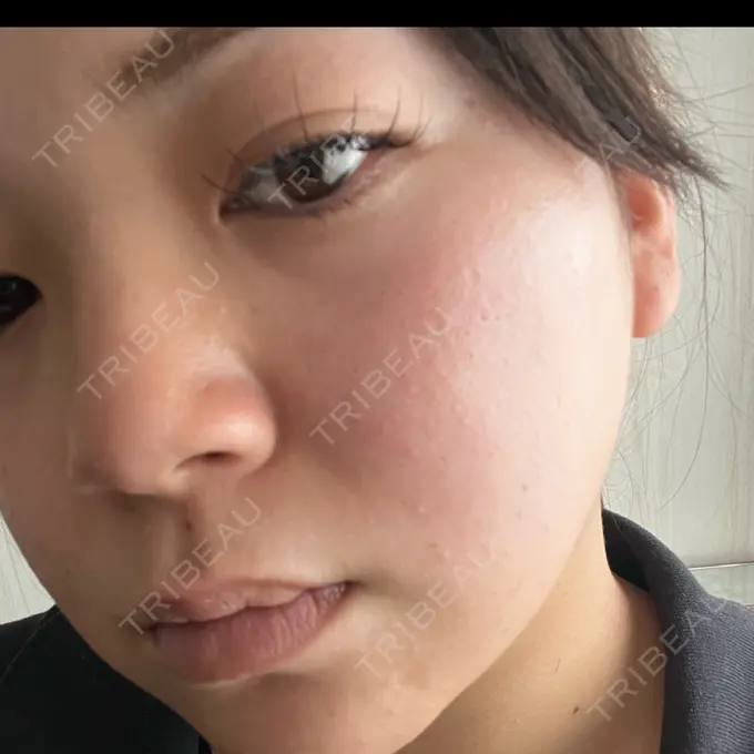 ルメッカ 東京美容外科 名古屋院 DAY 5 メイン用