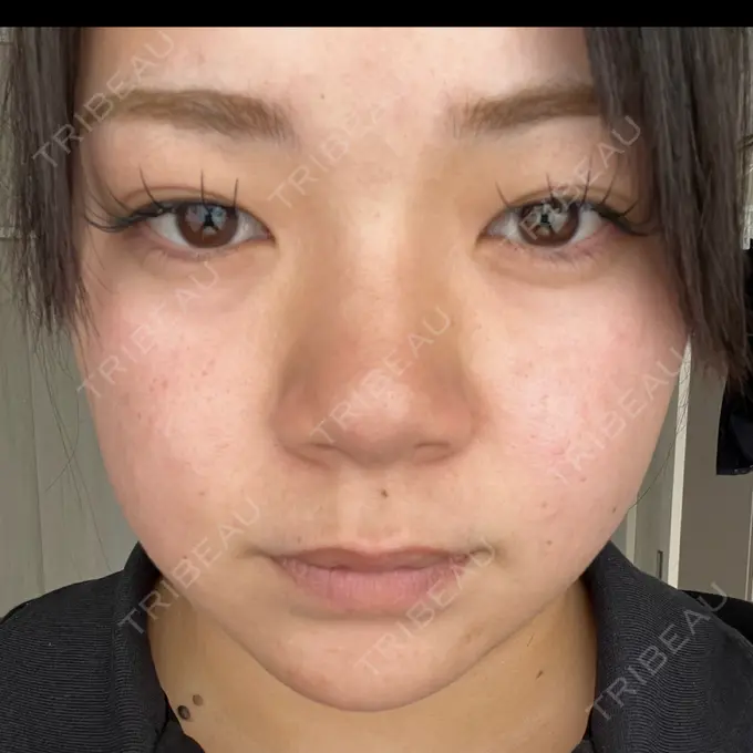 ルメッカ 東京美容外科 名古屋院 DAY 5 メイン用