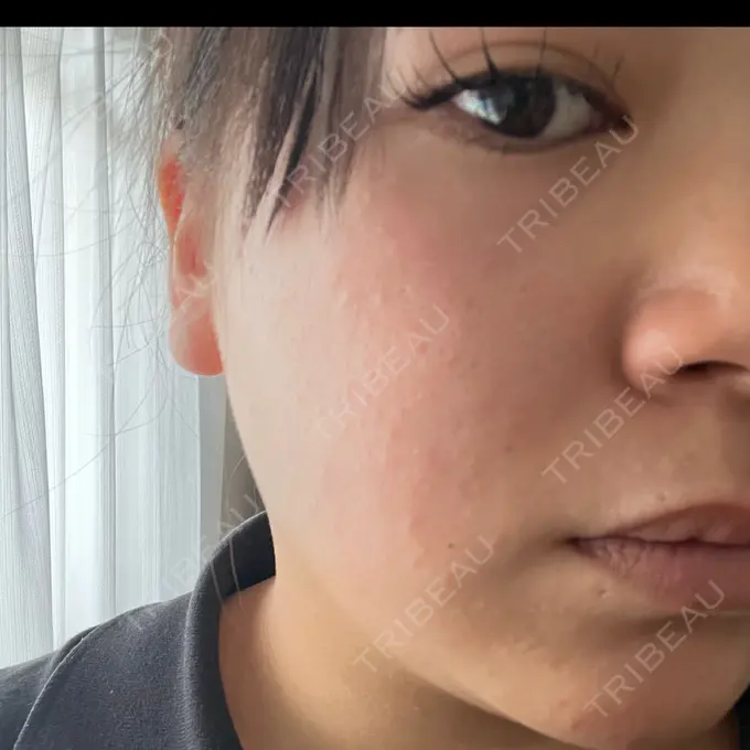 ルメッカ 東京美容外科 名古屋院 DAY 5 メイン用