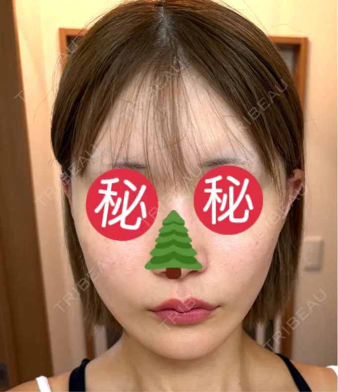 切開リフト GRACY TOKYO CLINIC【グレイシートウキョウクリニック】 DAY 1 メイン用