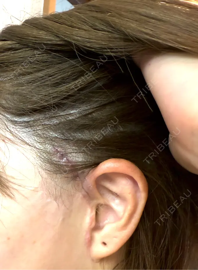 切開リフト GRACY TOKYO CLINIC【グレイシートウキョウクリニック】 DAY 1 メイン用