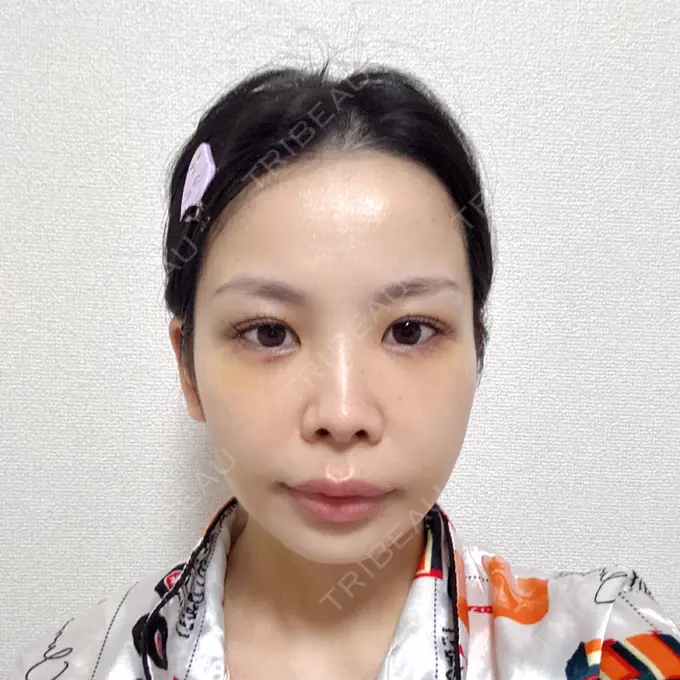 脂肪吸引（顔） 小倉美容外科ネビュラクリニック DAY 7 メイン用