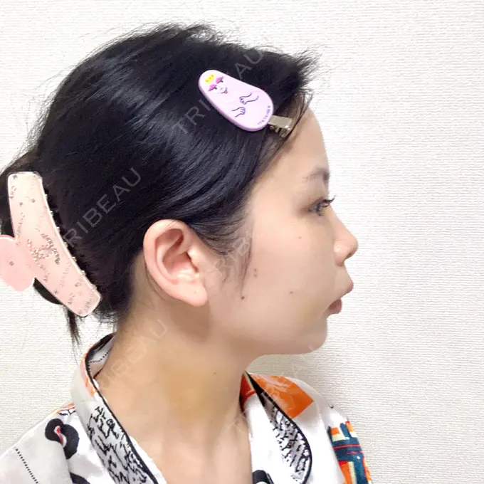 脂肪吸引（顔） 小倉美容外科ネビュラクリニック DAY 7 メイン用