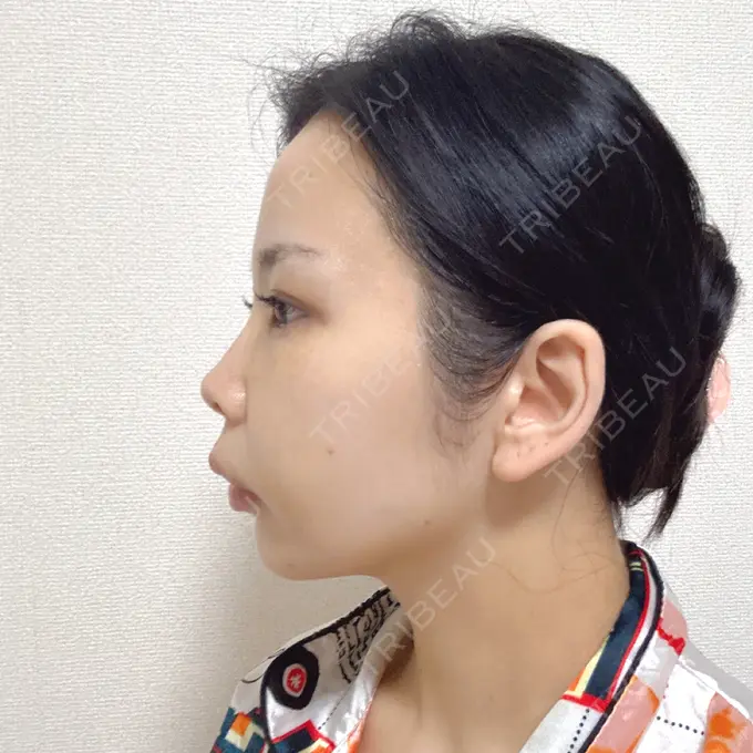 脂肪吸引（顔） 小倉美容外科ネビュラクリニック DAY 7 メイン用