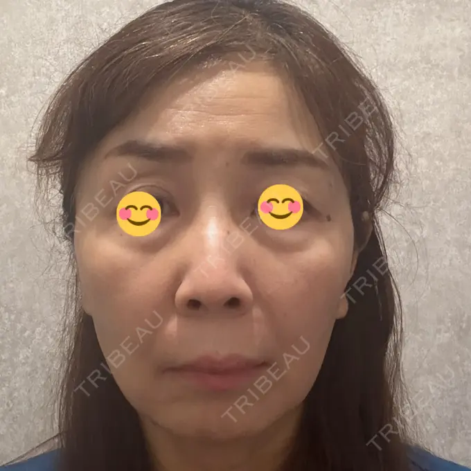 肌ヒアルロン酸注入（たるみ・シワ改善） / ヒアルロン酸注入（頬） / その他（口元） LIKI CLINIC KOBE DAY 0 メイン用