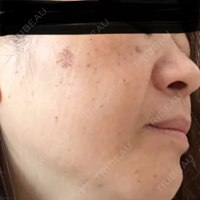 ピコレーザートーニング（美白・肝斑） / ピコスポット 東京シルククリニック 東京神田院 DAY 5 メイン用