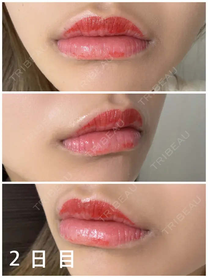 アートメイク（唇） 筋肉・美容クリニック DAY 2 メイン用