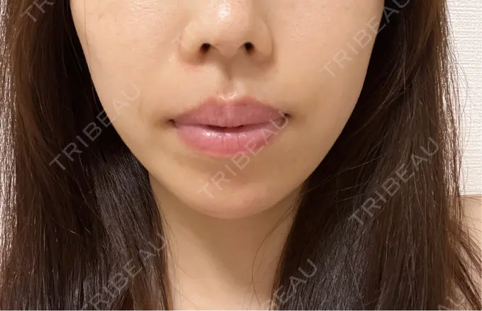 ボトックス（あご） / ボトックス（エラ・小顔） TCB東京中央美容外科 金山院 AFTER メイン用