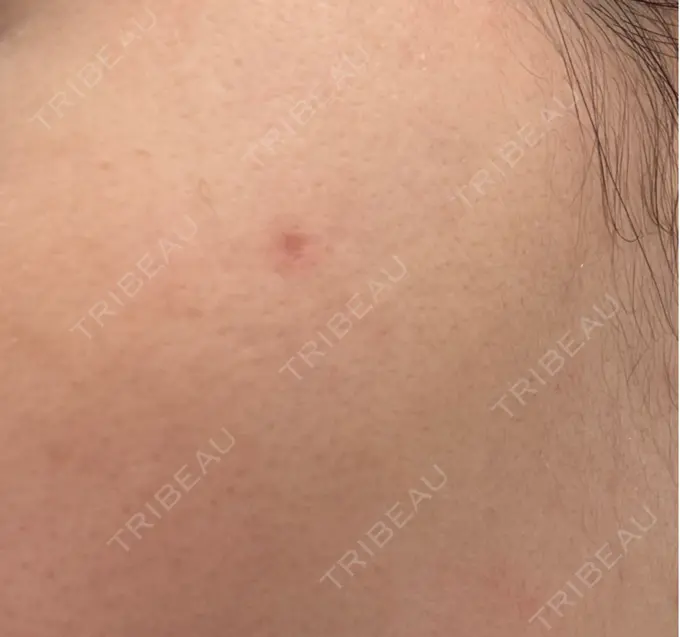 ほくろ・いぼ除去レーザー（肌） 共立美容外科 福岡院 AFTER メイン用