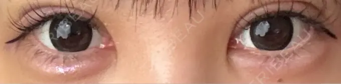 二重埋没 / 上まぶたの脂肪取り / ヒアルロン酸注入（涙袋） アリエル美容クリニック 横浜院 DAY 7 メイン用