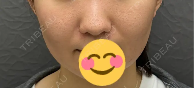 小鼻縮小（切開） 渋谷の森クリニック DAY 28 メイン用