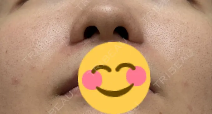 小鼻縮小（切開） 渋谷の森クリニック DAY 28 メイン用