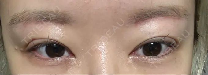 下まぶたの脂肪取り / 眉下切開 東京中央クリニック DAY 34 メイン用