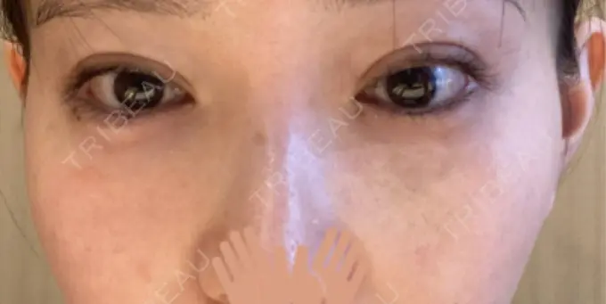 ヒアルロン酸溶解 EOL CLINIC【オルクリニック】 DAY 6 メイン用