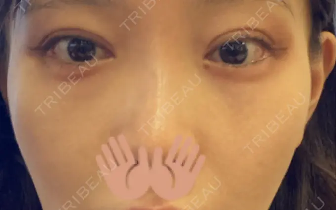 ヒアルロン酸溶解 EOL CLINIC【オルクリニック】 DAY 7 メイン用