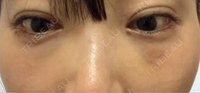 ヒアルロン酸溶解 EOL CLINIC【オルクリニック】 DAY 4 メイン用