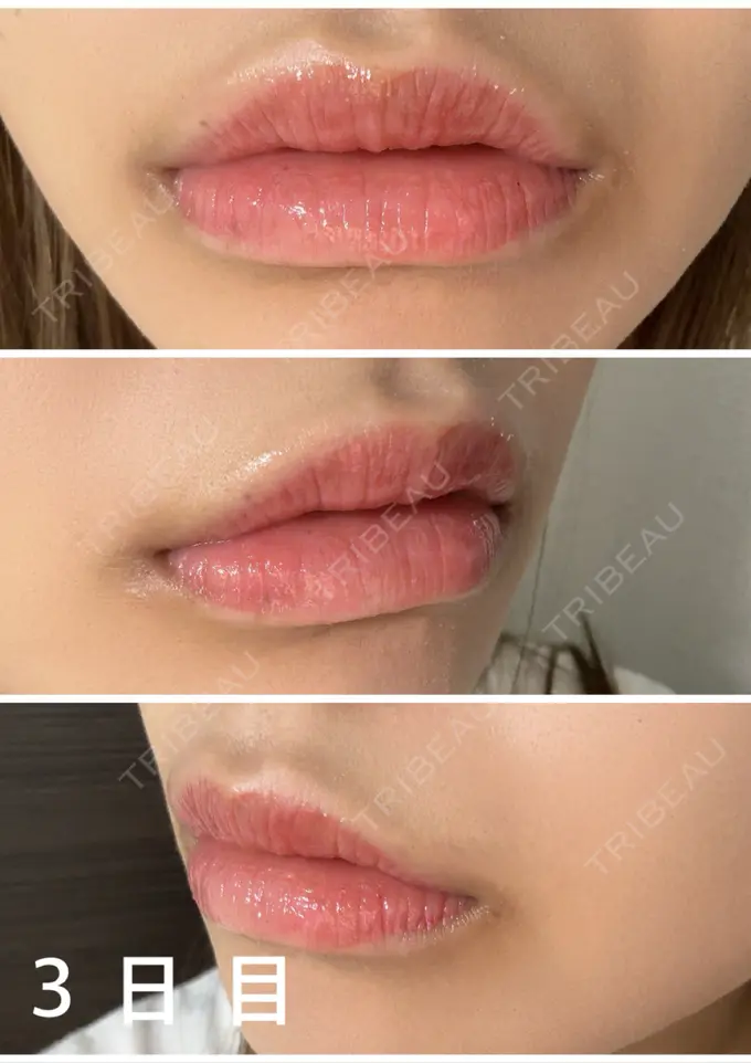 アートメイク（唇） 筋肉・美容クリニック DAY 3 メイン用