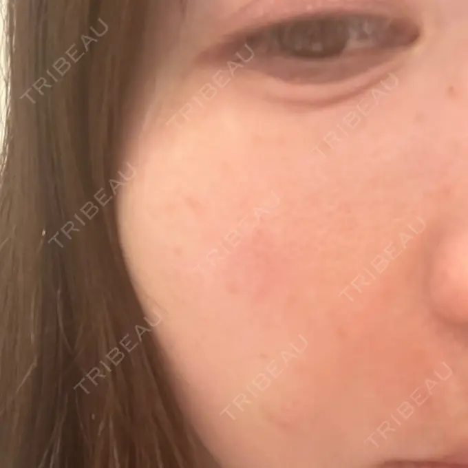 ヒアルロン酸注入（涙袋） / ヒアルロン酸注入（鼻） / 肌ヒアルロン酸注入（たるみ・シワ改善） / ヒアルロン酸注入（目の下） AI Beauty Clinic （エーアイ美容クリニック） AFTER メイン用