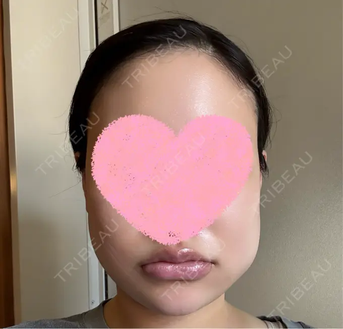 骨切り（あご） / 脂肪吸引（顔） WOM CLINIC GINZA （ワム クリニック ギンザ） DAY 2 メイン用