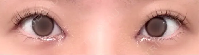 目頭切開 PRISM Beauty Clinic 町田院 DAY 3 メイン用