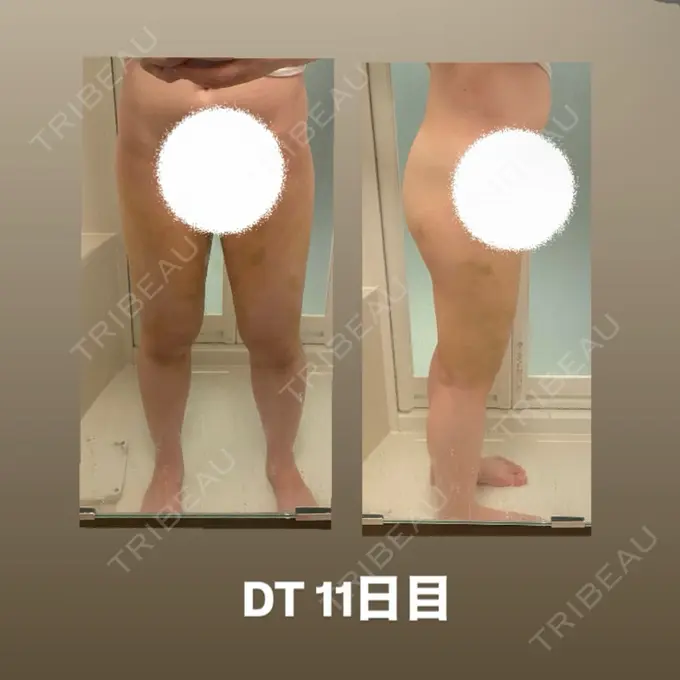 脂肪吸引（脚） 水の森美容クリニック 東京銀座院 DAY 11 メイン用