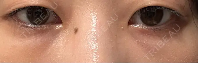 クマ治療 / 下まぶたたるみ取り / 下まぶたの脂肪取り / その他（目元） ROOTS Clinic DAY 6 メイン用