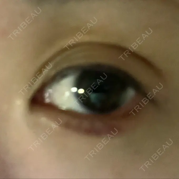 二重埋没 / ヒアルロン酸注入（涙袋） / ボトックス（エラ・小顔） / ヒアルロン酸注入（唇） / ボトックス（眉間） ネビュラクリニック 東京錦糸町院 DAY 27 メイン用