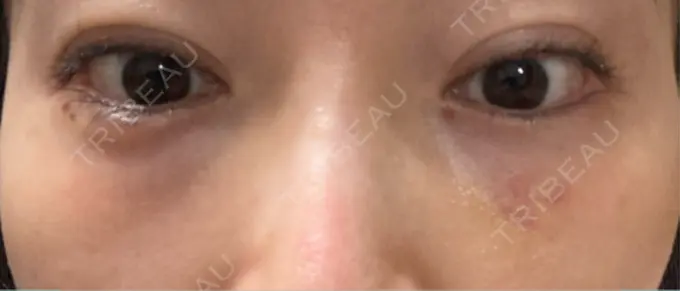 ヒアルロン酸溶解 EOL CLINIC【オルクリニック】 DAY 8 メイン用