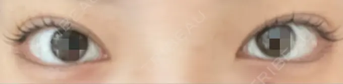 二重埋没 ROOTS Clinic AFTER メイン用