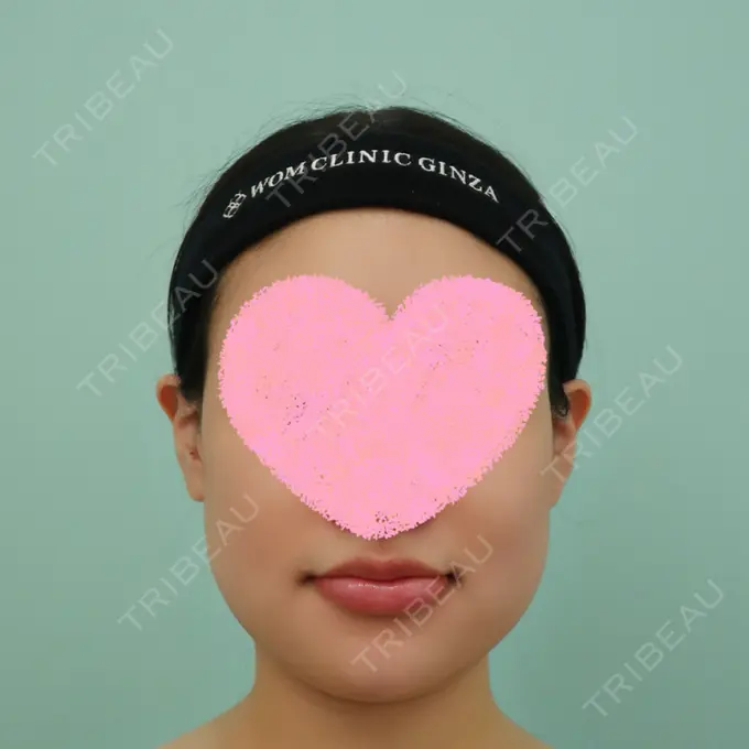 骨切り（あご） / 脂肪吸引（顔） WOM CLINIC GINZA （ワム クリニック ギンザ） DAY 3 メイン用