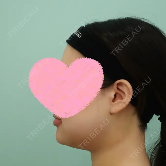 骨切り（あご） / 脂肪吸引（顔） WOM CLINIC GINZA （ワム クリニック ギンザ） DAY 3 メイン用