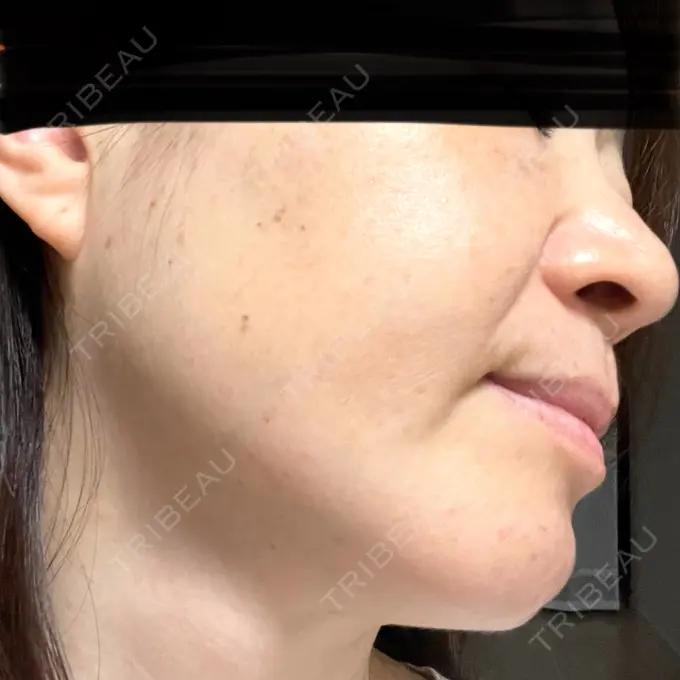 ピコレーザートーニング（美白・肝斑） / ピコスポット 東京シルククリニック 東京神田院 DAY 7 メイン用