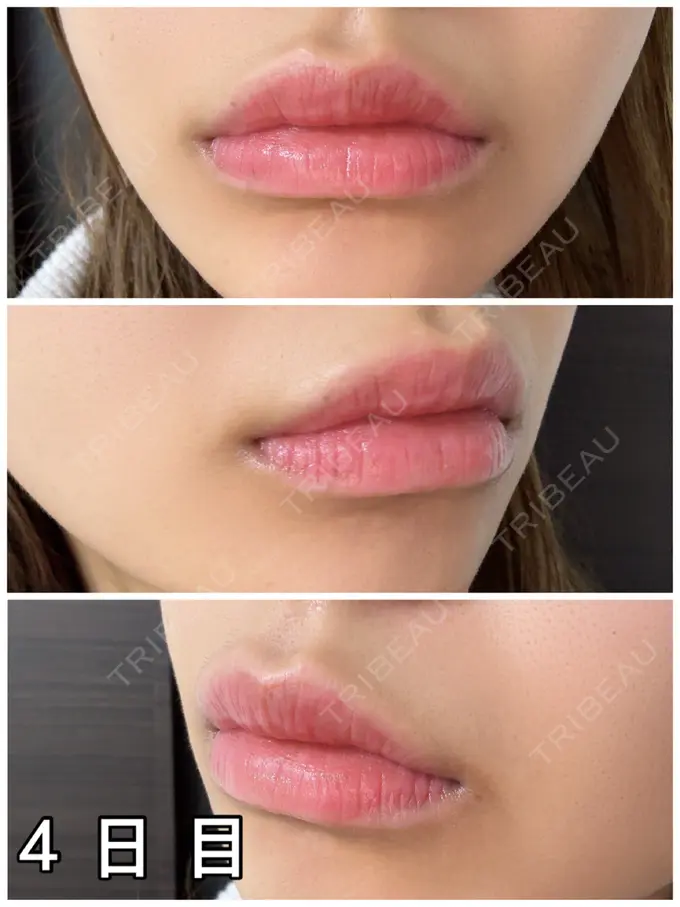 アートメイク（唇） 筋肉・美容クリニック DAY 4 メイン用