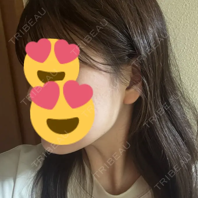 RF（高周波）たるみ治療 / その他（輪郭） Clinic K Blossom DAY 11 メイン用