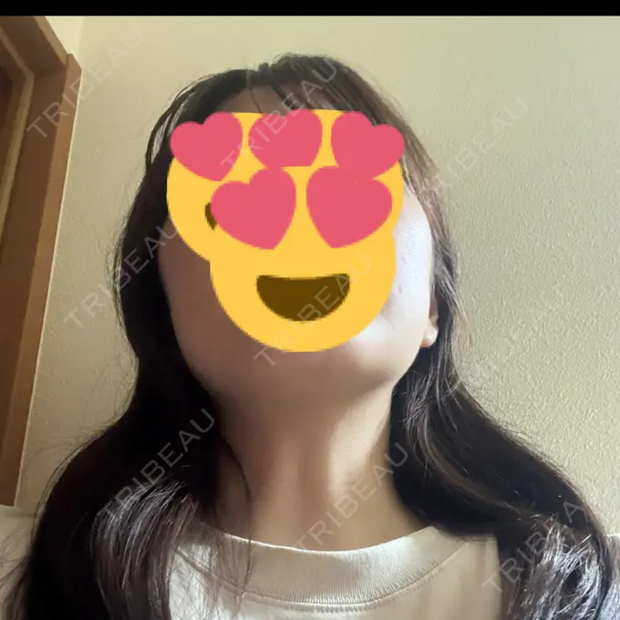 RF（高周波）たるみ治療 / その他（輪郭） Clinic K Blossom DAY 11 メイン用