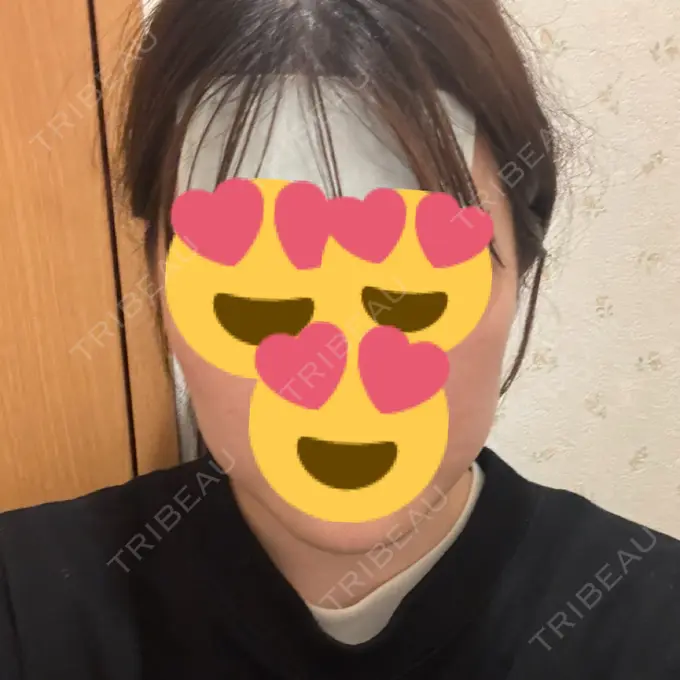 RF（高周波）たるみ治療 / その他（輪郭） Clinic K Blossom DAY 12 メイン用