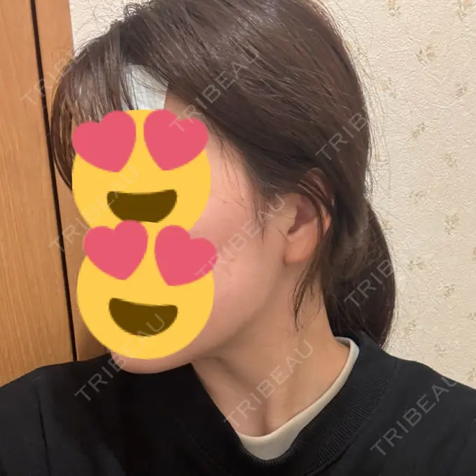 RF（高周波）たるみ治療 / その他（輪郭） Clinic K Blossom DAY 12 メイン用