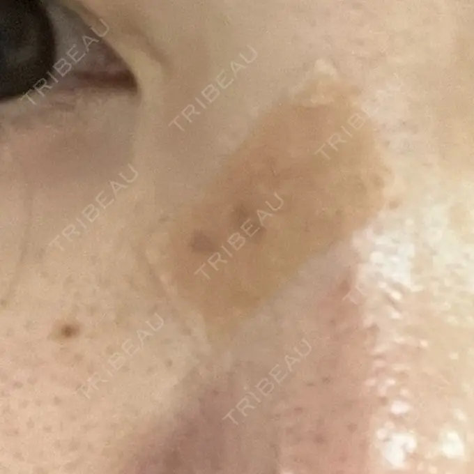 レーザートーニング（美白・肝斑） / ピコスポット ZX-CLINIC AFTER メイン用