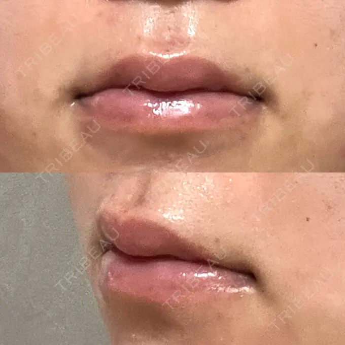 ヒアルロン酸注入（唇） 大美会クリニック 神戸院 DAY 7 メイン用