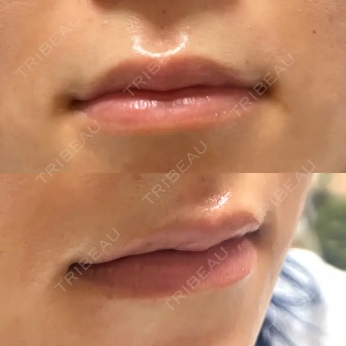 ヒアルロン酸注入（唇） 大美会クリニック 神戸院 DAY 9 メイン用